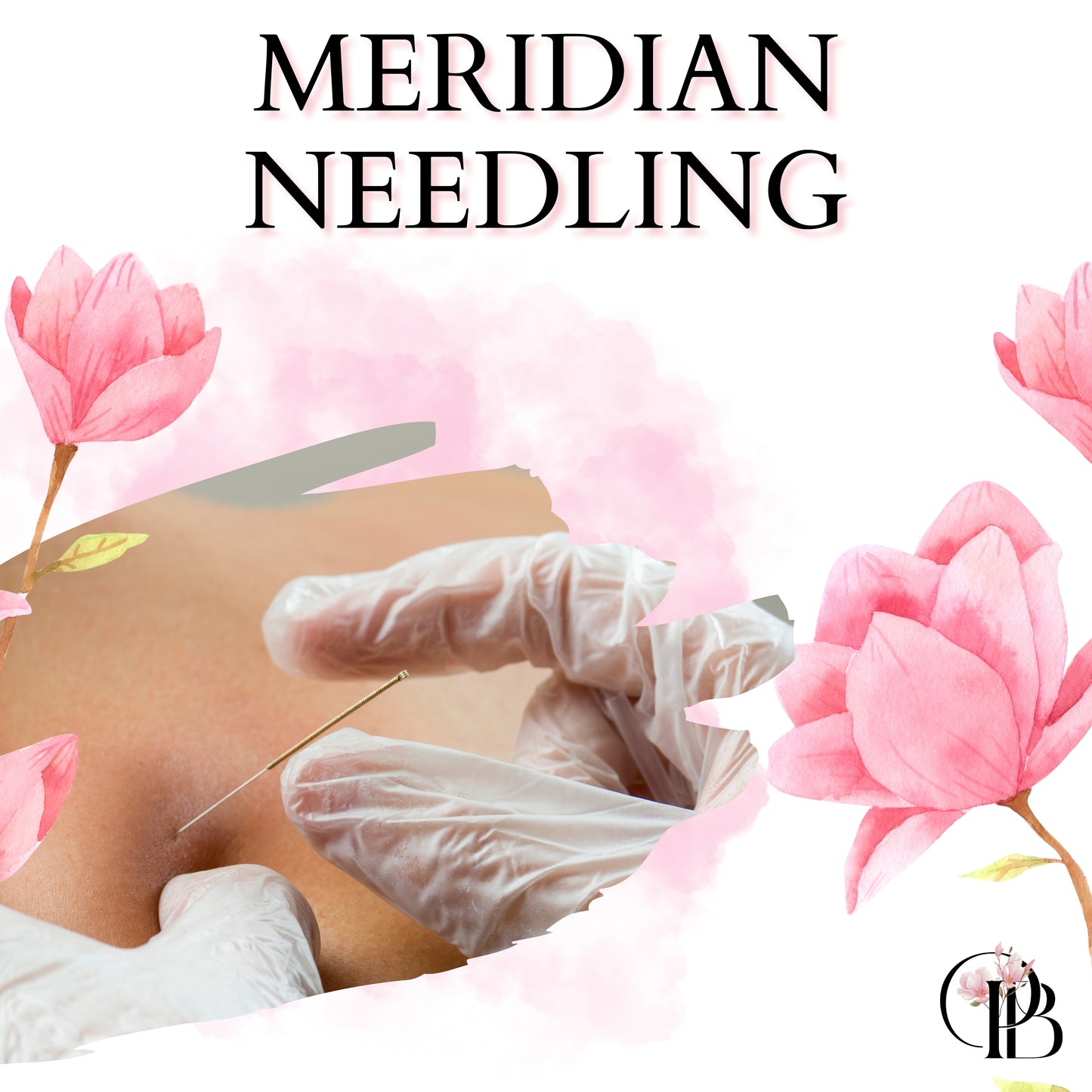 Meridian Needling